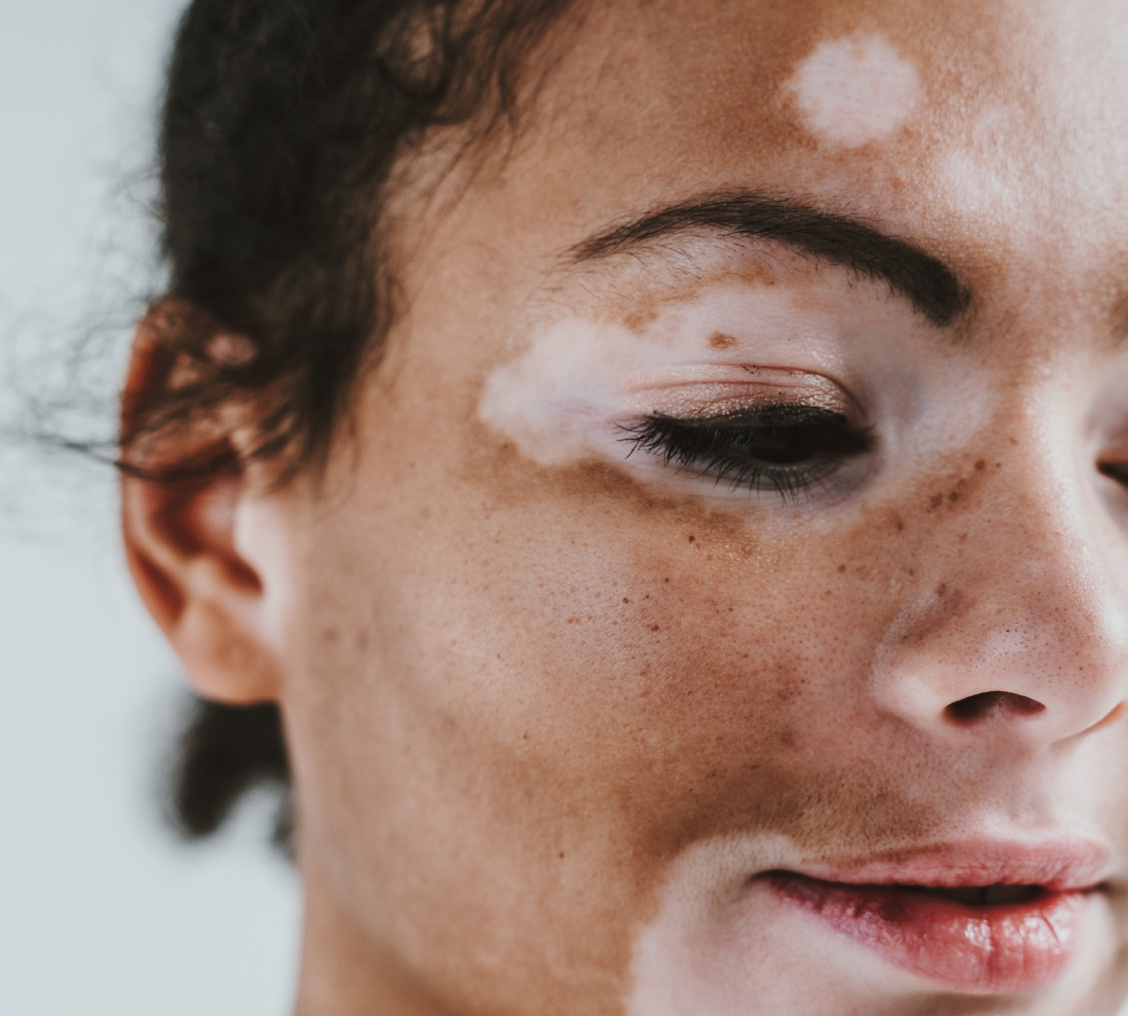 Onde está a representatividade de pessoas com vitiligo? — Gama Revista
